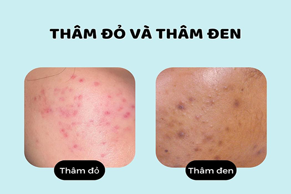 kem trị mụn thâm trắng da, kem tri mun tham trang da, top 5 kem trị thâm mụn, kem trắng da trị thâm mụn, kem trị mụn thâm trắng da hiệu quả, kem face trị mụn thâm trắng da, kem trị mụn thâm đỏ, sản phẩm trị mụn và thâm, kem dưỡng trắng trị thâm mụn