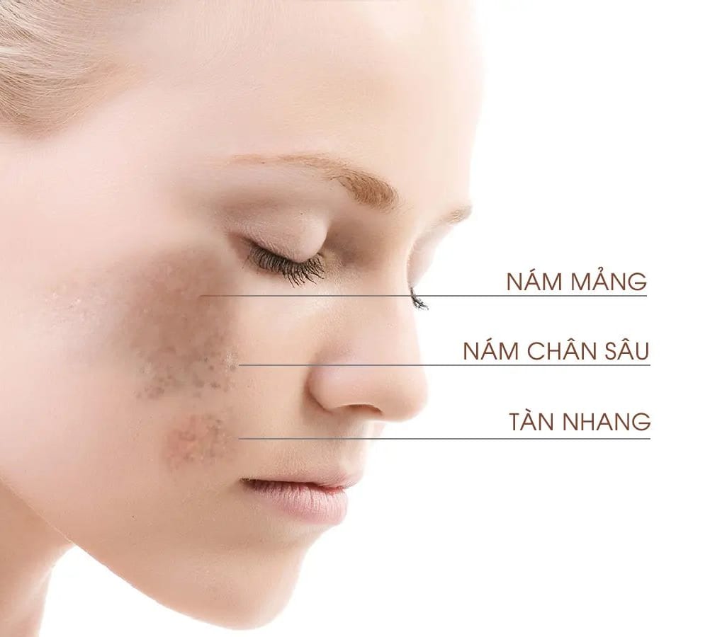 Nám da được chia thành 3 loại