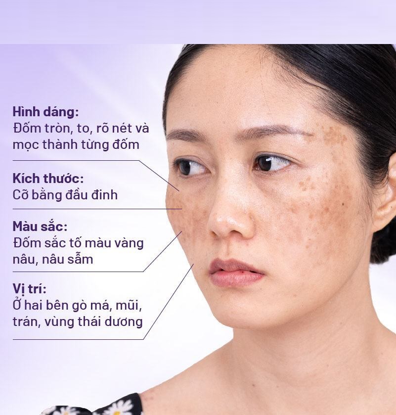 Biểu hiện của nám chân sâu