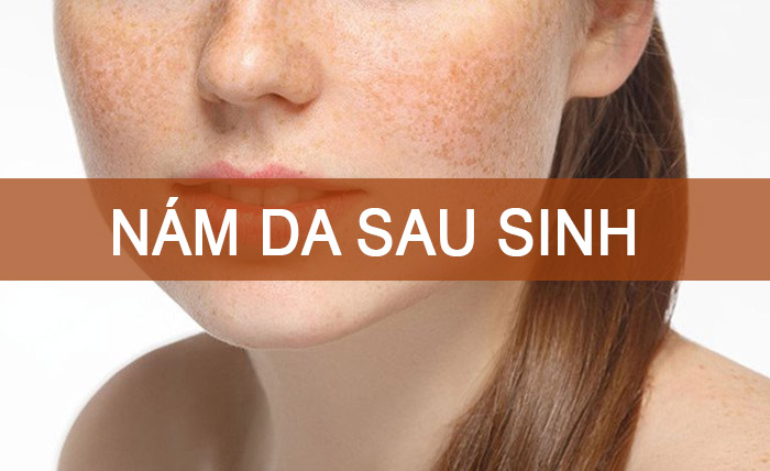 Nám da sau sinh gây mất thẩm mỹ