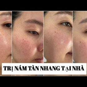 trị nám tàn nhang tại nhà