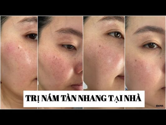 trị nám tàn nhang tại nhà